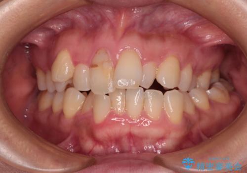 骨格的なズレを歯列矯正でカバー ワイヤー装置での非抜歯矯正