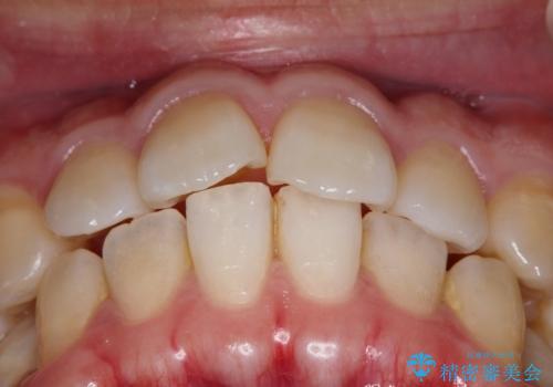 【インビザライン】目立たない矯正で前歯を綺麗にの治療前
