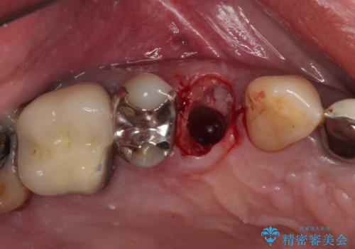 抜歯は避けたい? 1DAYインプラントに魅せられて抜歯即時埋入インプラントによる補綴治療の治療中
