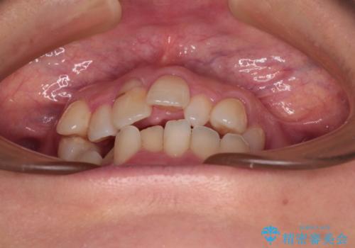 骨格的なズレを歯列矯正でカバー ワイヤー装置での非抜歯矯正の治療前