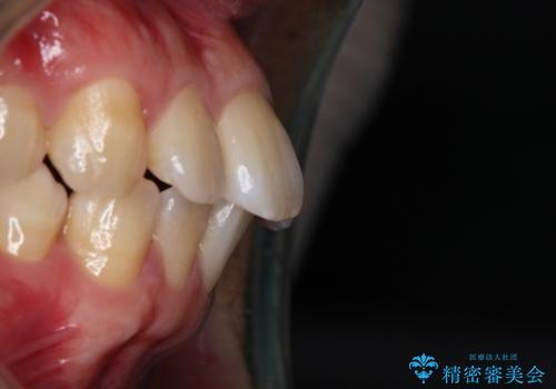 【インビザライン】目立たない矯正で前歯を綺麗にの治療前