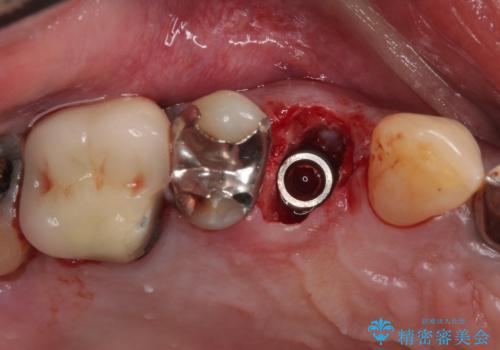 抜歯は避けたい? 1DAYインプラントに魅せられて抜歯即時埋入インプラントによる補綴治療の治療後