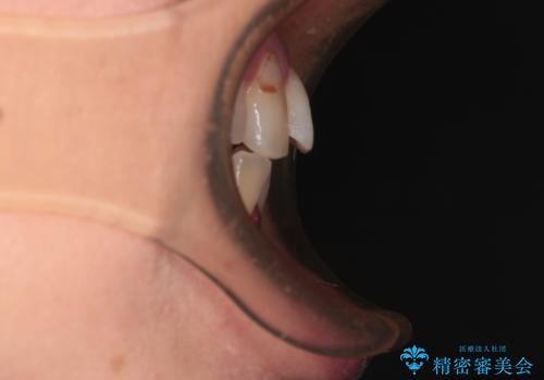 骨格的なズレを歯列矯正でカバー ワイヤー装置での非抜歯矯正の治療前