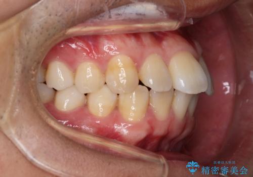 【インビザライン】目立たない矯正で前歯を綺麗にの治療前
