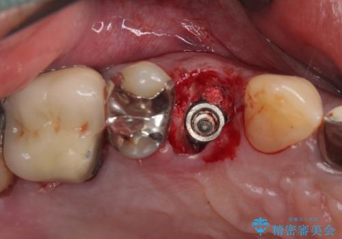 抜歯は避けたい? 1DAYインプラントに魅せられて抜歯即時埋入インプラントによる補綴治療の治療前