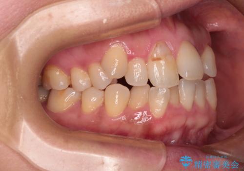 骨格的なズレを歯列矯正でカバー ワイヤー装置での非抜歯矯正の治療前