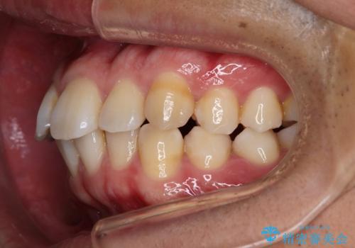 【インビザライン】目立たない矯正で前歯を綺麗にの治療前