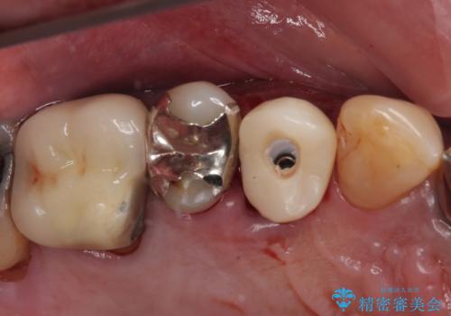 抜歯は避けたい? 1DAYインプラントに魅せられて抜歯即時埋入インプラントによる補綴治療の治療中