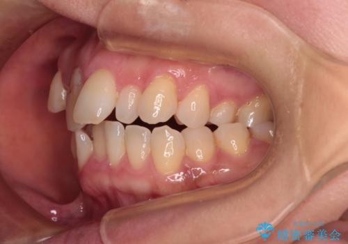 骨格的なズレを歯列矯正でカバー ワイヤー装置での非抜歯矯正の治療前