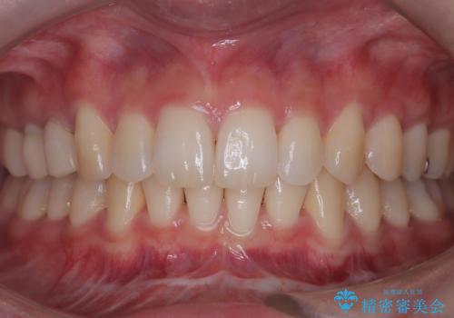 白い歯で、好印象をゲット!の症例 治療前