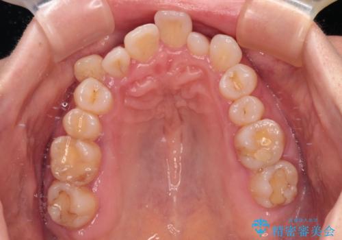骨格的なズレを歯列矯正でカバー ワイヤー装置での非抜歯矯正の治療前
