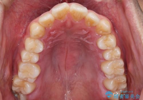 【インビザライン】目立たない矯正で前歯を綺麗にの治療前