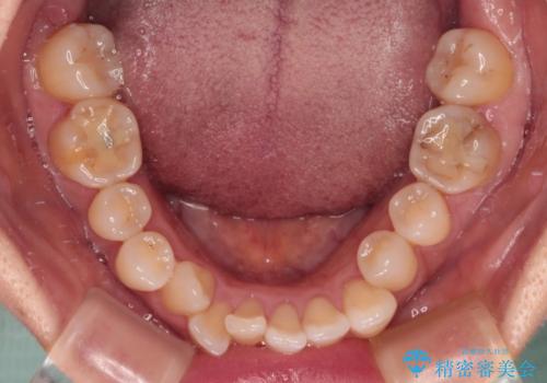 骨格的なズレを歯列矯正でカバー ワイヤー装置での非抜歯矯正の治療前