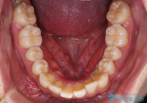 【インビザライン】目立たない矯正で前歯を綺麗にの治療前