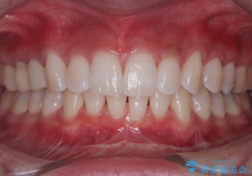 白い歯で、好印象をゲット!の症例 治療後