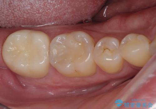 違和感が続く奥歯 慎重な診断を行ったむし歯治療の症例 治療後