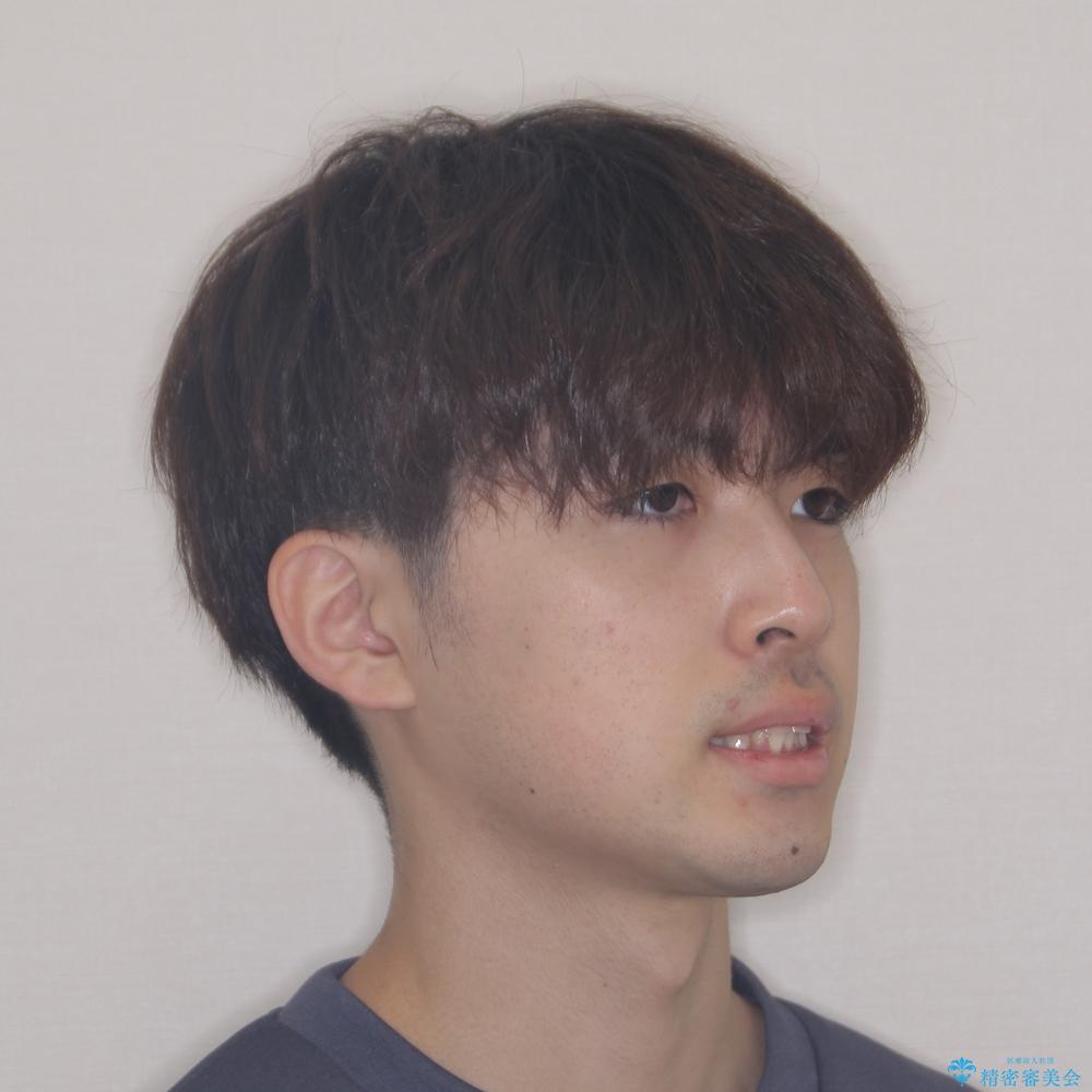 【モニター】出っ歯と奥歯の咬み合わせを改善 補助装置を用いたワイヤー抜歯矯正の治療前(顔貌)