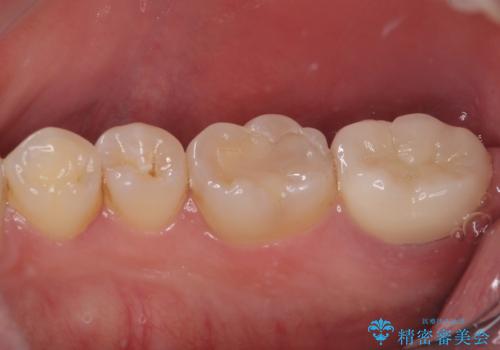 違和感が続く奥歯 慎重な診断を行ったむし歯治療の治療後