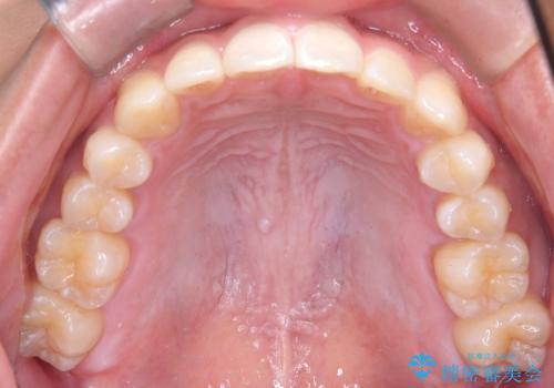必ずしもワイヤーでなくても大丈夫!インビザラインでデコボコ歯列&過蓋咬合を改善の治療後