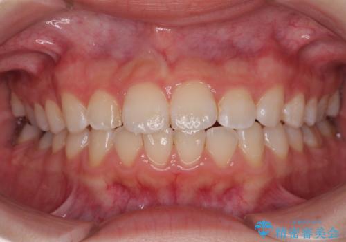 気になる前歯を矯正 短期間のワイヤー矯正治療の症例 治療後