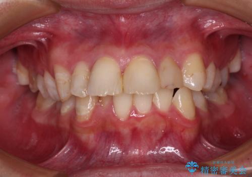 【モニター】出っ歯と奥歯の咬み合わせを改善 補助装置を用いたワイヤー抜歯矯正の症例 治療前