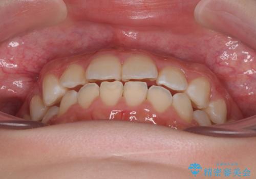 気になる前歯を矯正 短期間のワイヤー矯正治療の治療後