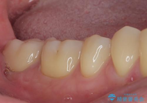 違和感が続く奥歯 慎重な診断を行ったむし歯治療の治療後
