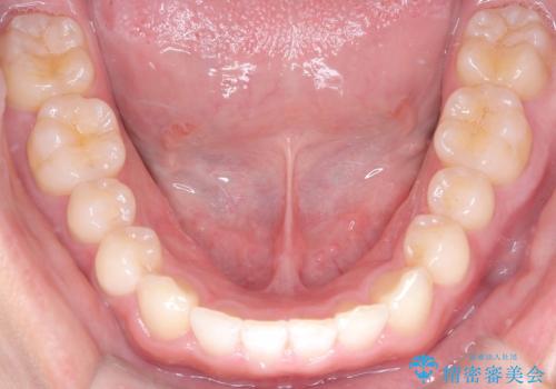 必ずしもワイヤーでなくても大丈夫!インビザラインでデコボコ歯列&過蓋咬合を改善の治療後