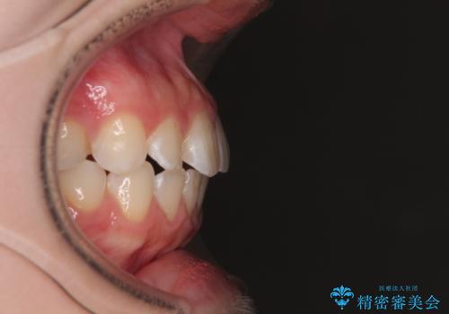 気になる前歯を矯正 短期間のワイヤー矯正治療の治療後