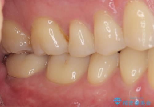 違和感が続く奥歯 慎重な診断を行ったむし歯治療の治療後