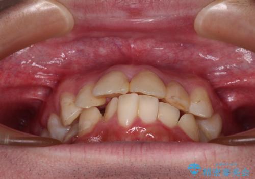 【モニター】出っ歯と奥歯の咬み合わせを改善 補助装置を用いたワイヤー抜歯矯正の治療前