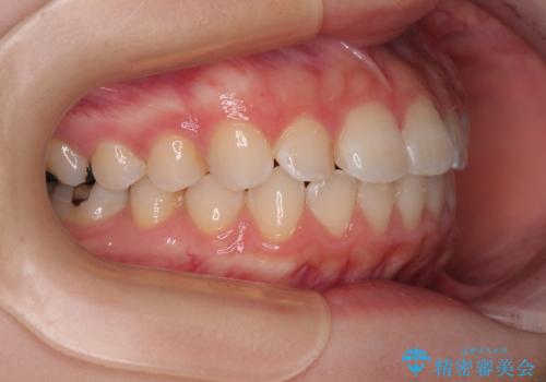 気になる前歯を矯正 短期間のワイヤー矯正治療の治療後