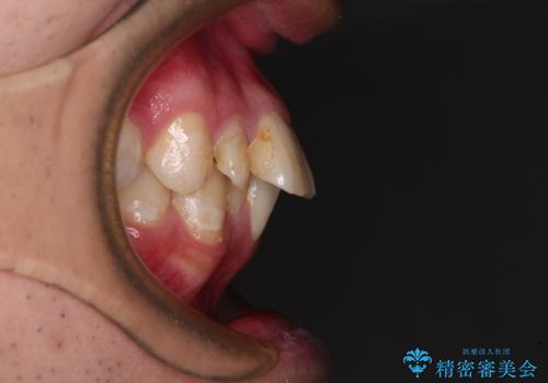 【モニター】出っ歯と奥歯の咬み合わせを改善 補助装置を用いたワイヤー抜歯矯正の治療前