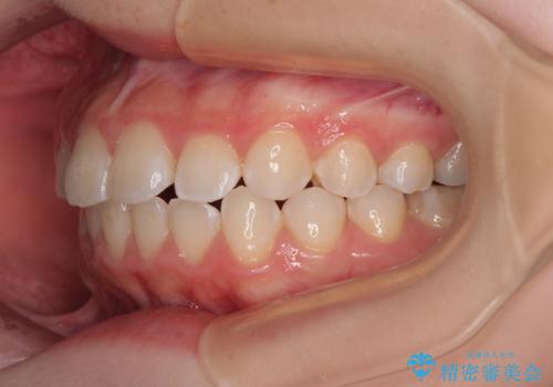 気になる前歯を矯正 短期間のワイヤー矯正治療の治療後