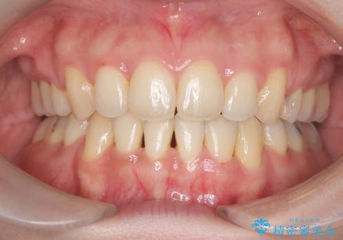 口ボコと歯のデコボコが気になる!|前歯が出ていて口が閉じにくい|審美ワイヤー矯正による口元の改善!の治療後