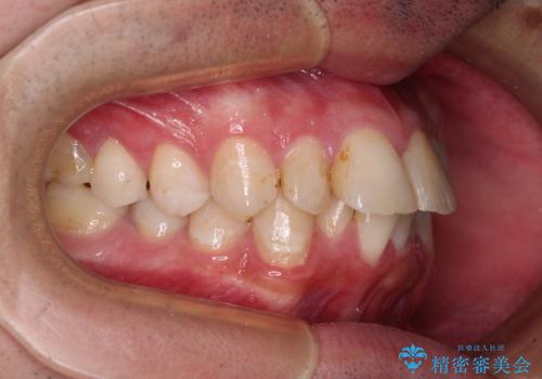 【モニター】出っ歯と奥歯の咬み合わせを改善 補助装置を用いたワイヤー抜歯矯正の治療前