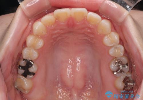 気になる前歯を矯正 短期間のワイヤー矯正治療の治療後