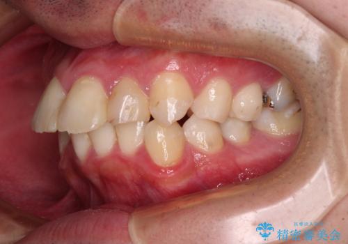 【モニター】出っ歯と奥歯の咬み合わせを改善 補助装置を用いたワイヤー抜歯矯正の治療前