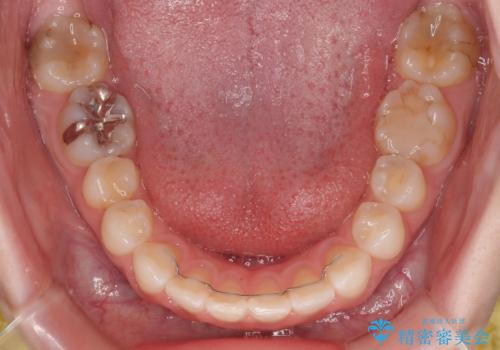 気になる前歯を矯正 短期間のワイヤー矯正治療の治療後