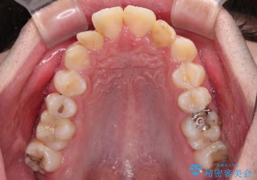 【モニター】出っ歯と奥歯の咬み合わせを改善 補助装置を用いたワイヤー抜歯矯正の治療前