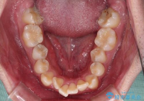【モニター】出っ歯と奥歯の咬み合わせを改善 補助装置を用いたワイヤー抜歯矯正の治療前