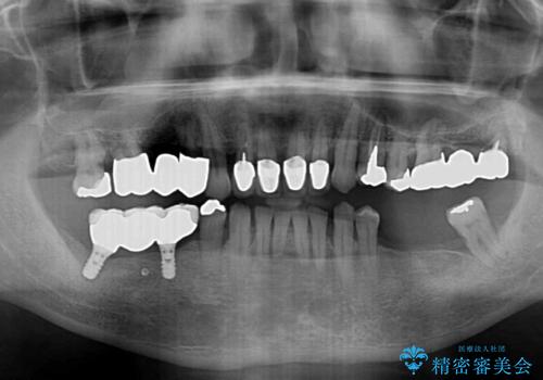 強い咬合力で奥歯がボロボロに インプラント治療による咬合回復と全顎セラミック治療の治療前