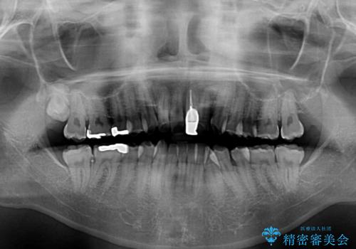 気になる前歯のデコボコと八重歯 ワイヤー矯正ですっきりとの治療前