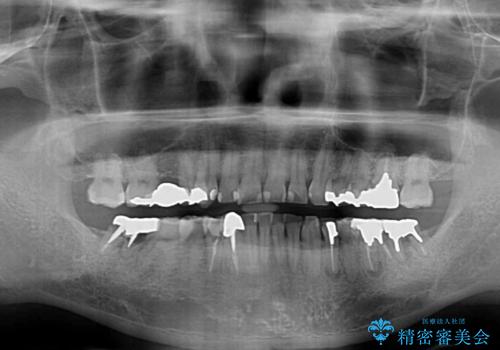 銀歯を白くしたい 一緒に矯正治療も行ない美しい口腔内にの治療前