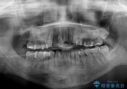 骨格的なズレを歯列矯正でカバー　ワイヤー装置での非抜歯矯正の治療前