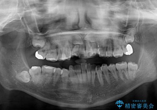 永久歯が埋もれて乳歯が残存 叢生改善のワイヤー抜歯矯正の治療前
