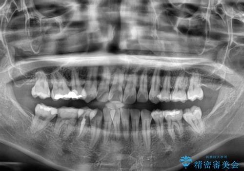 矯正治療の後戻り インビザラインで短期間矯正治療の治療前