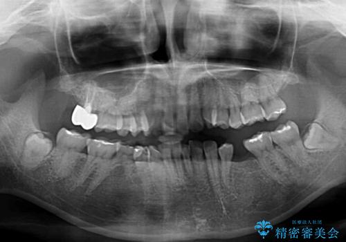 デコボコと乳歯の欠損 ワイヤー矯正とインプラント補綴治療の治療前