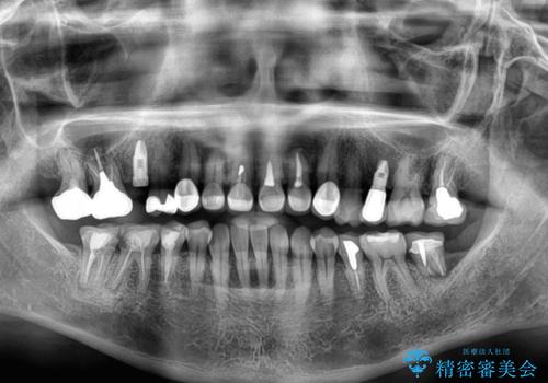 新幹線通院 地元で断られた奥歯のむし歯治療の治療前