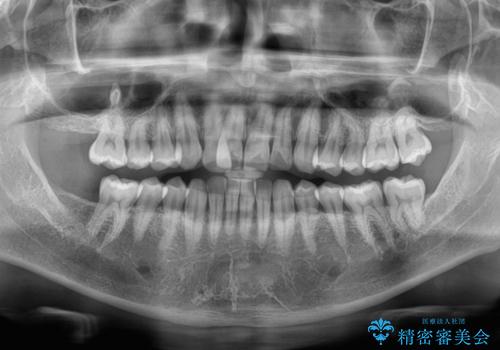 インビザラインは煩わしい ワイヤー矯正で短期間矯正治療の治療前